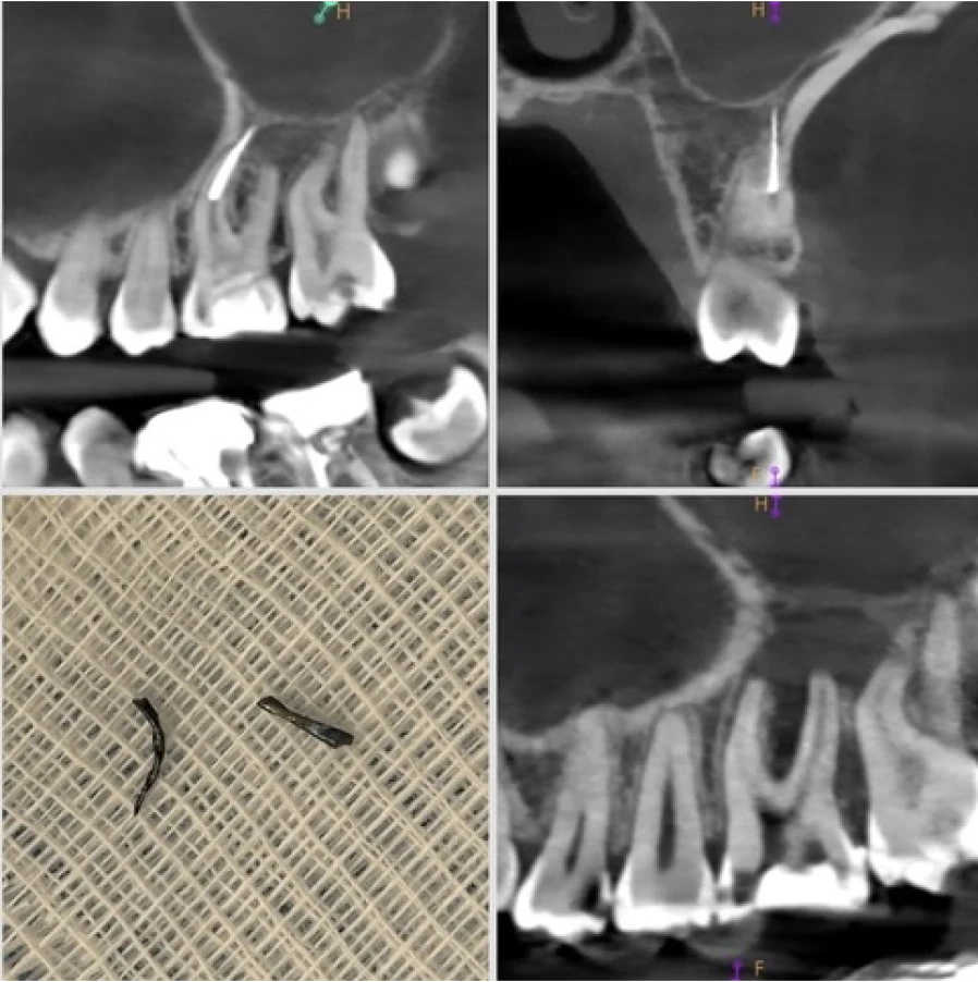 ablation lime fracture Ablation Lime fracture Dentistes Essonne | Apolline Dental Care