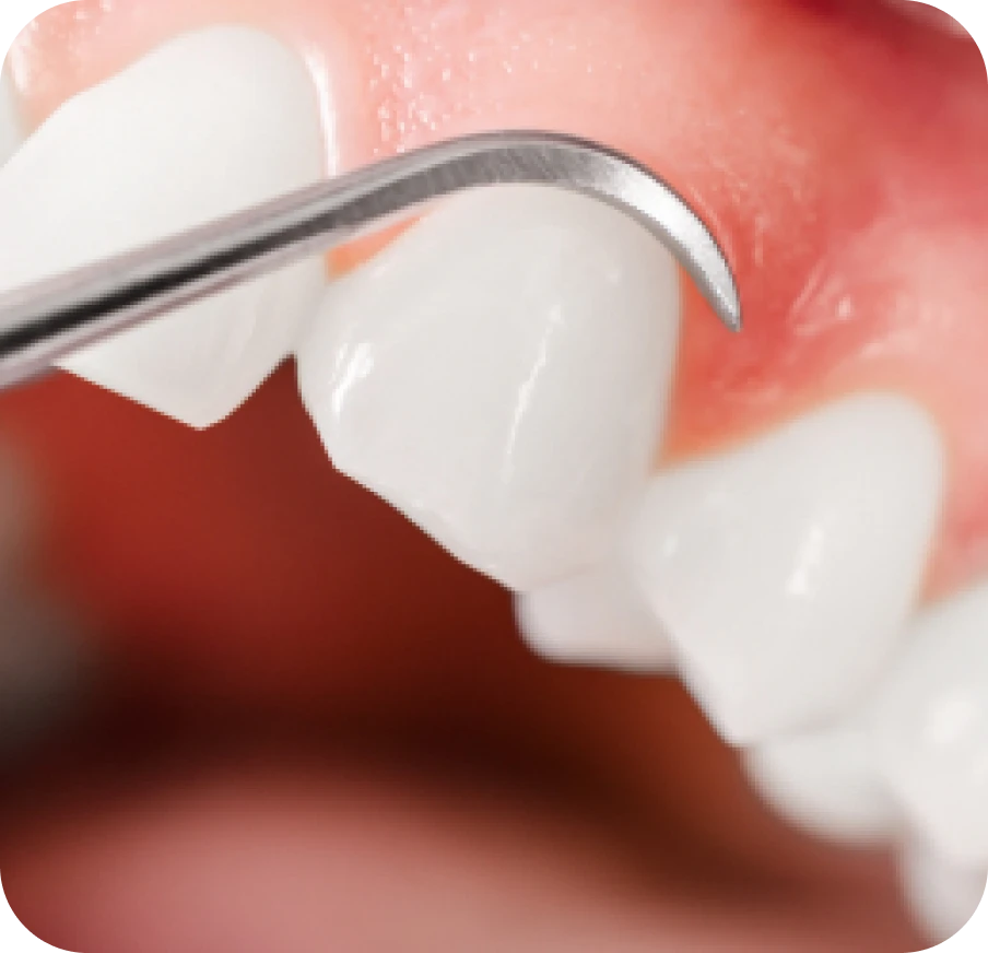 traitement gencives docteur gaspar Greffe de gencive Fontenay-le-Vicomte Dentistes Essonne | Apolline Dental Care