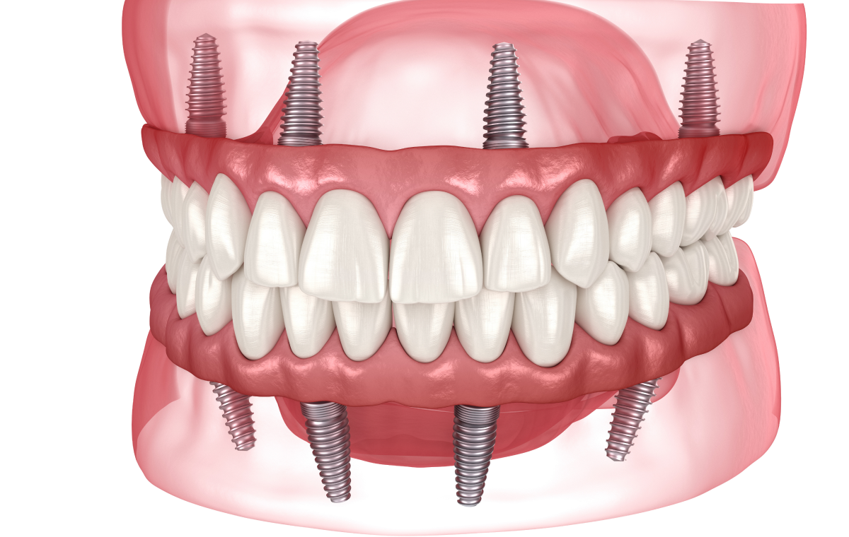 all on 4 all on 6 corbeil essonnes Reconstruction osseuse complexe Dentistes Essonne | Apolline Dental Care