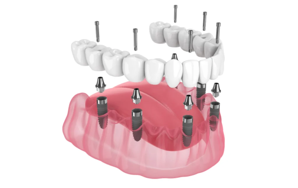 all on 4 all on 6 saint pierre du perray All-on-4 / All-on-6 Dentistes Essonne | Apolline Dental Care