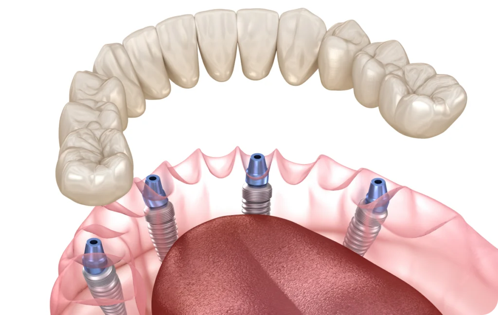 all on 4 all on 6 saintry sur seine All-on-4 / All-on-6 Dentistes Essonne | Apolline Dental Care