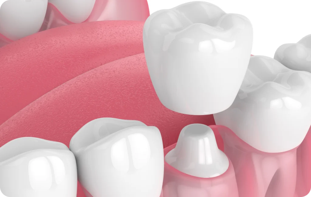 couronne dentaire corbeil essonnes couronne dentaire corbeil essonnes Soins esthétiques restaurateurs Dentistes Essonne | Apolline Dental Care