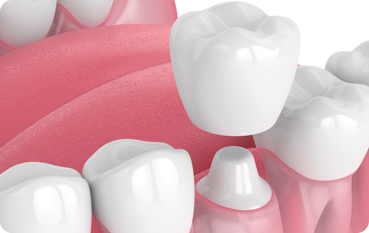 couronne dentaire corbeil essonnes Soins esthétiques restaurateurs Dentistes Essonne | Apolline Dental Care
