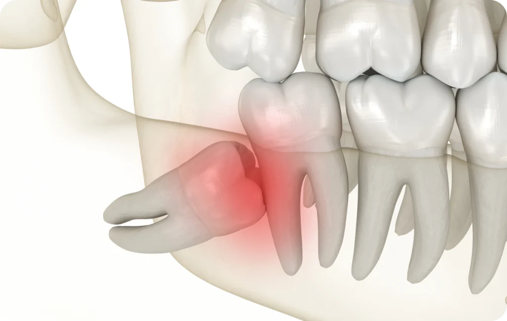 dents sagesse essonnes dents sagesse essonnes Dents de sagesse Dentistes Essonne | Apolline Dental Care