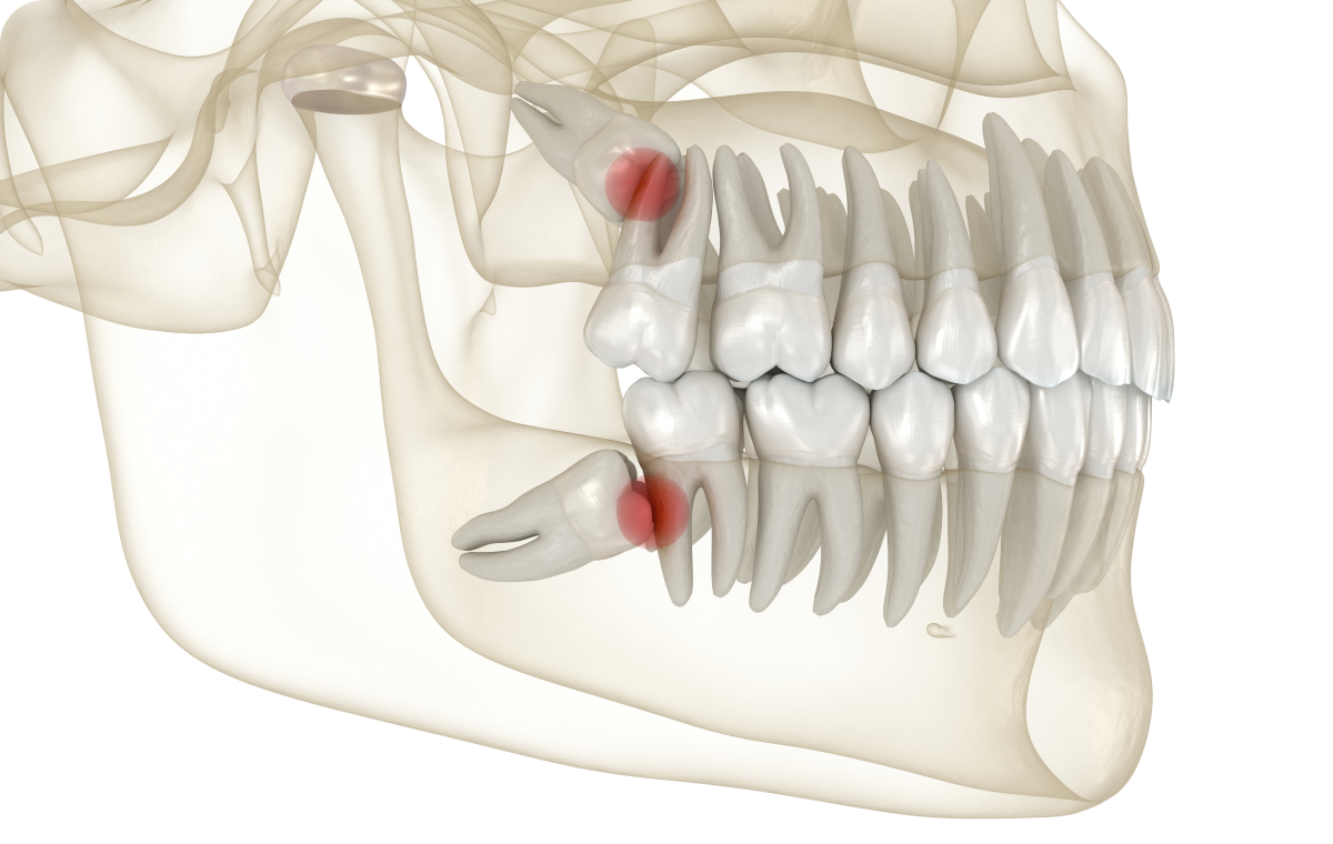 dents sagesse saint pierre du perray Dents de sagesse Dentistes Essonne | Apolline Dental Care