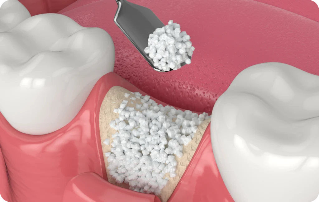 detartrage corbeil essonnes detartrage corbeil essonnes Reconstruction osseuse complexe Dentistes Essonne | Apolline Dental Care