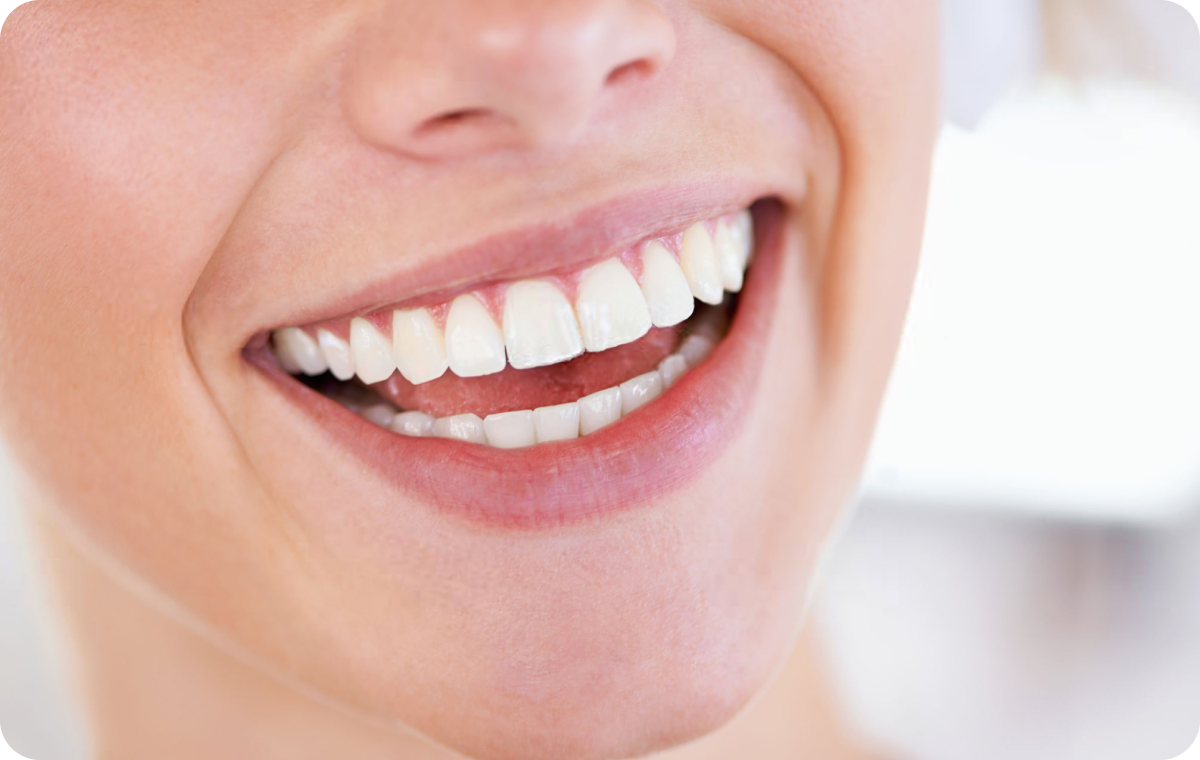 facettes dentaires corbeil essonnes Éclaircissement dentaire Dentistes Essonne | Apolline Dental Care