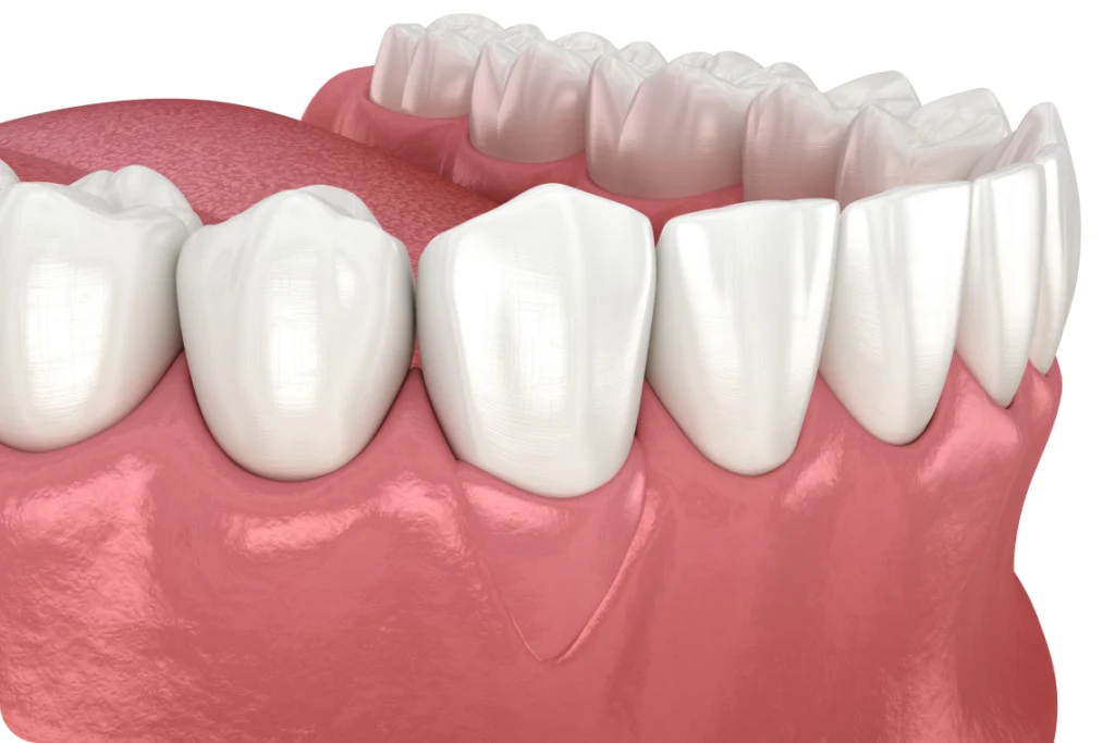 greffe gencive savigny le temple greffe gencive savigny le temple Greffe de gencive Saintry-sur-Seine Dentistes Essonne | Apolline Dental Care