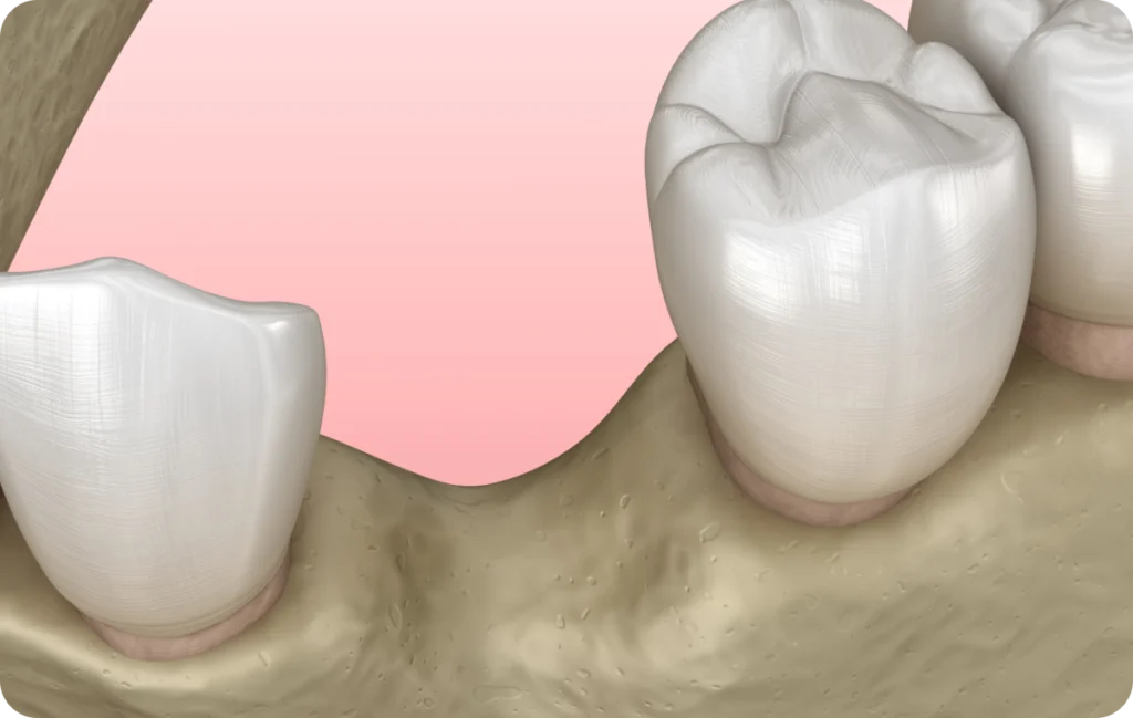 greffe osseuse fontenay le vicomte greffe osseuse fontenay le vicomte Chirurgie parodontale régénérative Dentistes Essonne | Apolline Dental Care