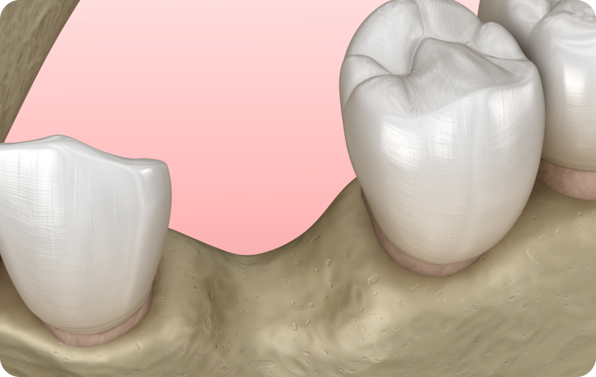 greffe osseuse fontenay le vicomte Chirurgie parodontale régénérative Dentistes Essonne | Apolline Dental Care