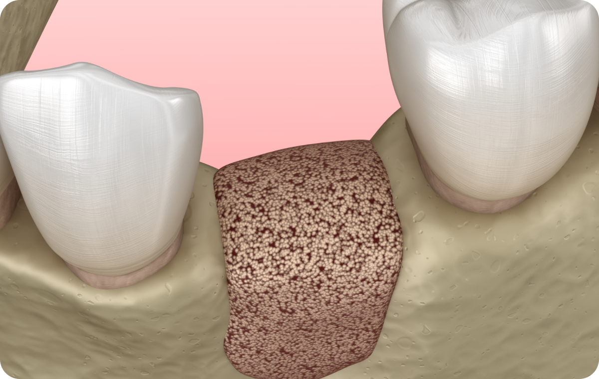 greffe osseuse savigny le temple Greffe de gencive Corbeil-Essonnes Dentistes Essonne | Apolline Dental Care