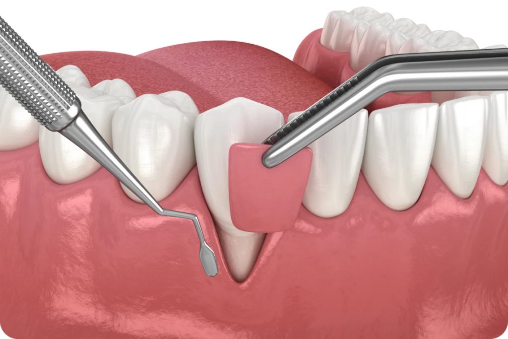 greffes gencives fontenay le vicomte Greffe de gencive Savigny-le-Temple Dentistes Essonne | Apolline Dental Care