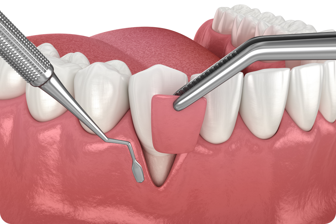 greffes gencives fontenay le vicomte Greffe de gencive Savigny-le-Temple Dentistes Essonne | Apolline Dental Care