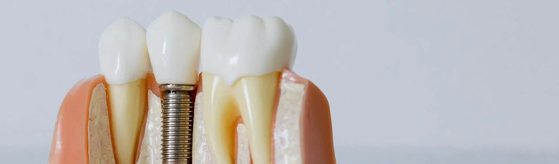 implant dentaire dentiste essonne  Dentistes Essonne | Apolline Dental Care