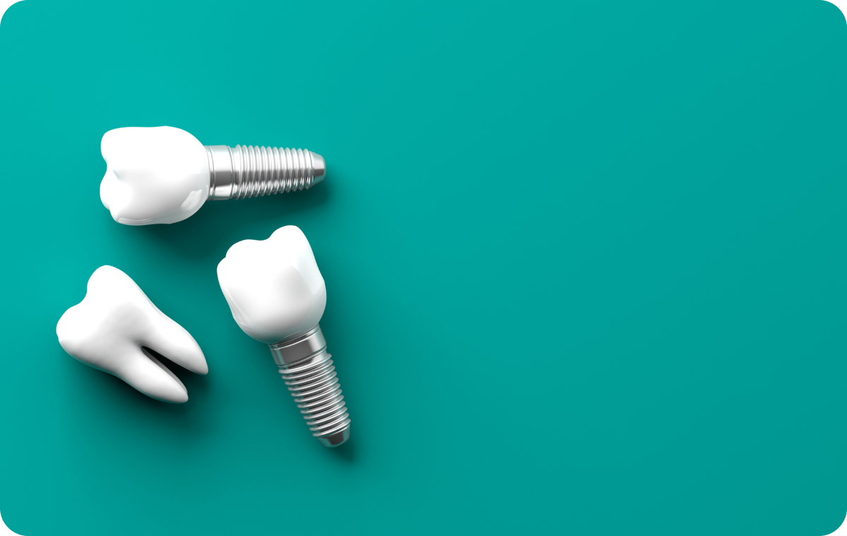 implant dentaire saint pierre du perray Implant dentaire Fontenay-le-Vicomte Dentistes Essonne | Apolline Dental Care