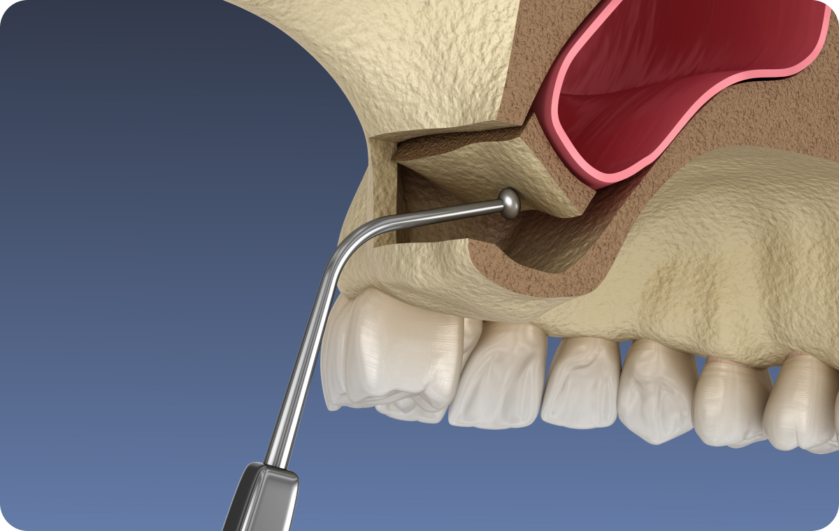 sinus lift savigny le temple Chirurgie du sinus ou Sinus Lift Dentistes Essonne | Apolline Dental Care