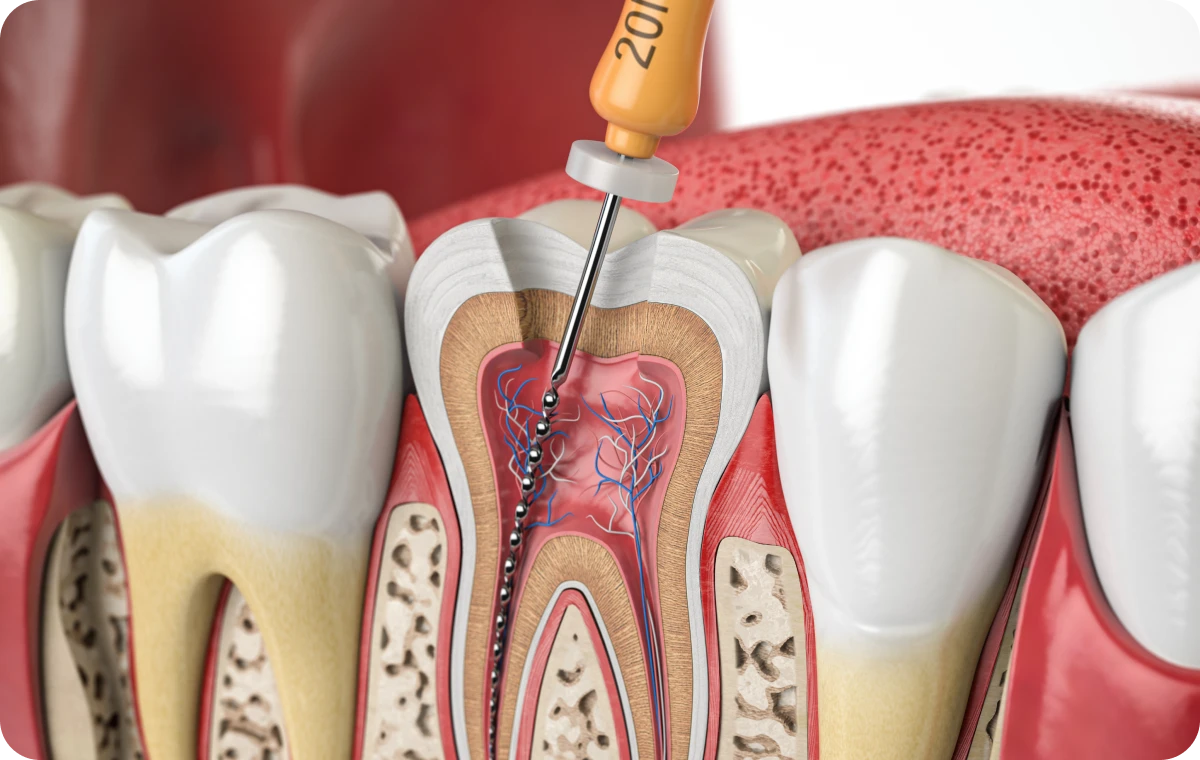 chirurgie endodontique essonne Traitement endodontique initial Dentistes Essonne | Apolline Dental Care