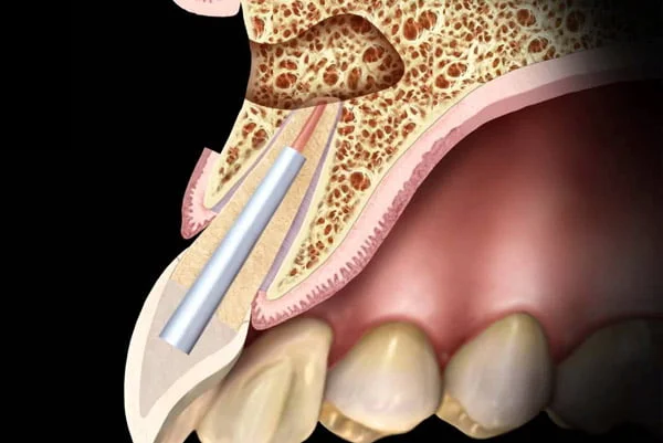 chirurgie endodontique Chirurgie endodontique – Résection apicale Dentiste Corbeil-Essonnes | Apolline Dental Care