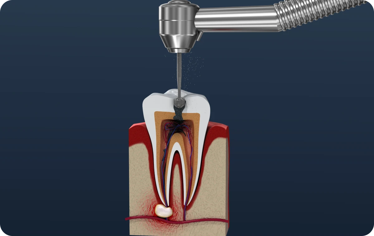 endodontie abces essonne Chirurgie endodontique – Résection apicale Dentistes Essonne | Apolline Dental Care