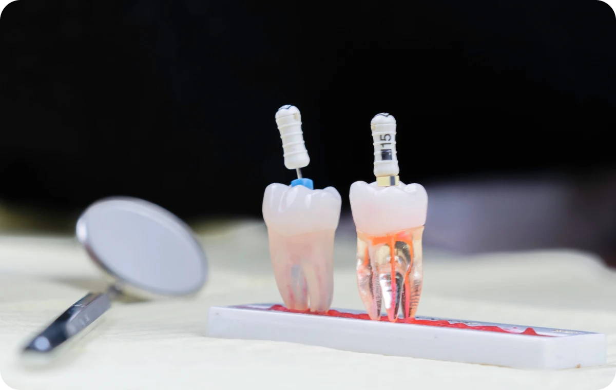 endodontie dentiste essonne Retrait d’instruments fracturés Dentistes Essonne | Apolline Dental Care