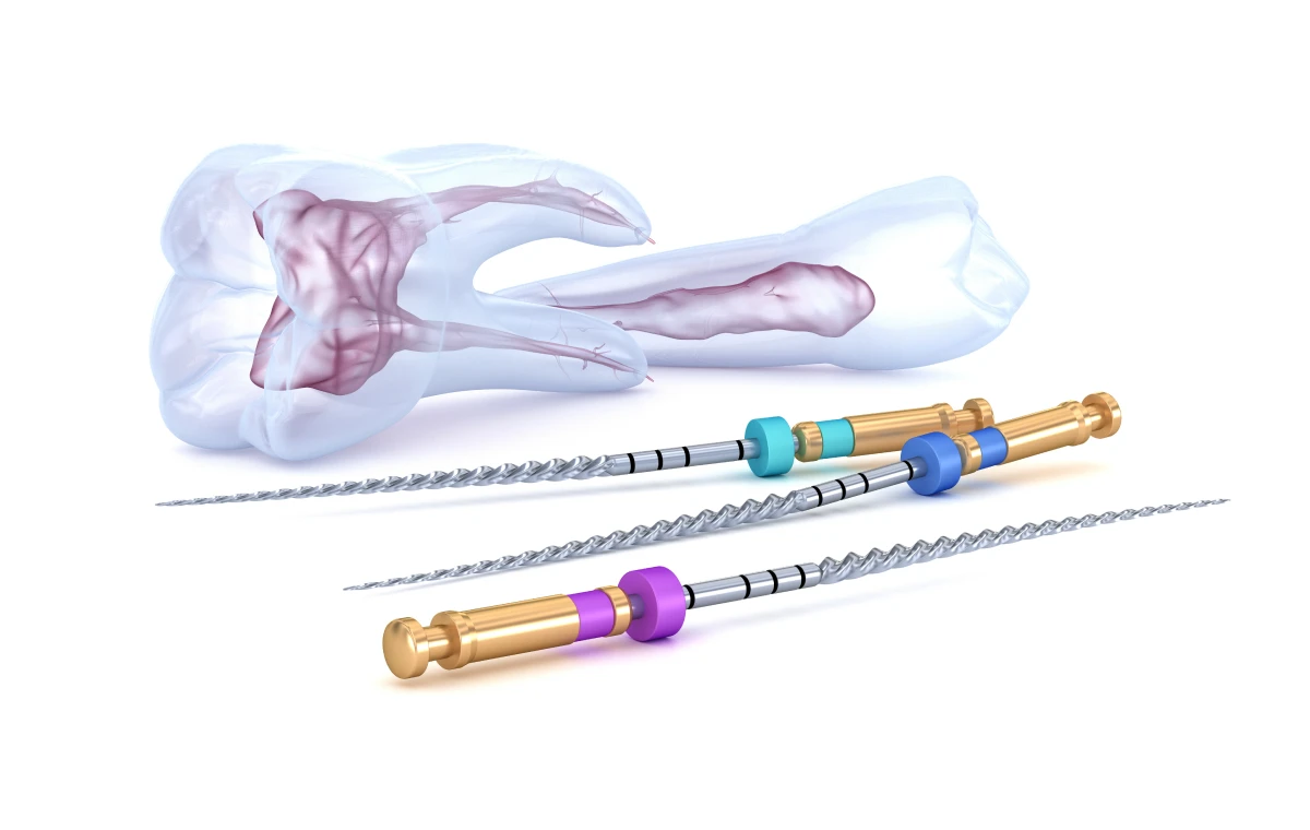 endodontie instruments essonne Retraitement endodontique Dentistes Essonne | Apolline Dental Care