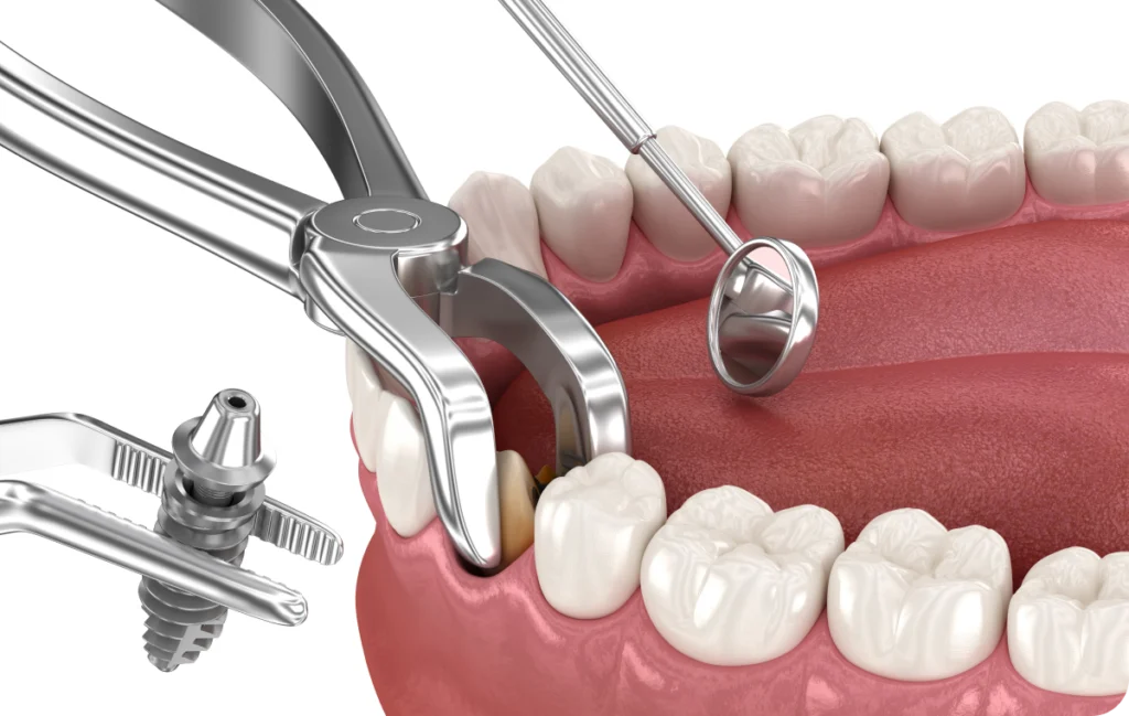 extraction implantation essonne extraction implantation essonne Extractions simples Dentistes Essonne | Apolline Dental Care