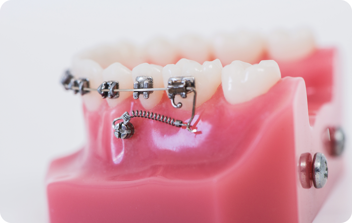 mini vis essonne Pose de mini-vis orthodontiques Dentistes Essonne | Apolline Dental Care