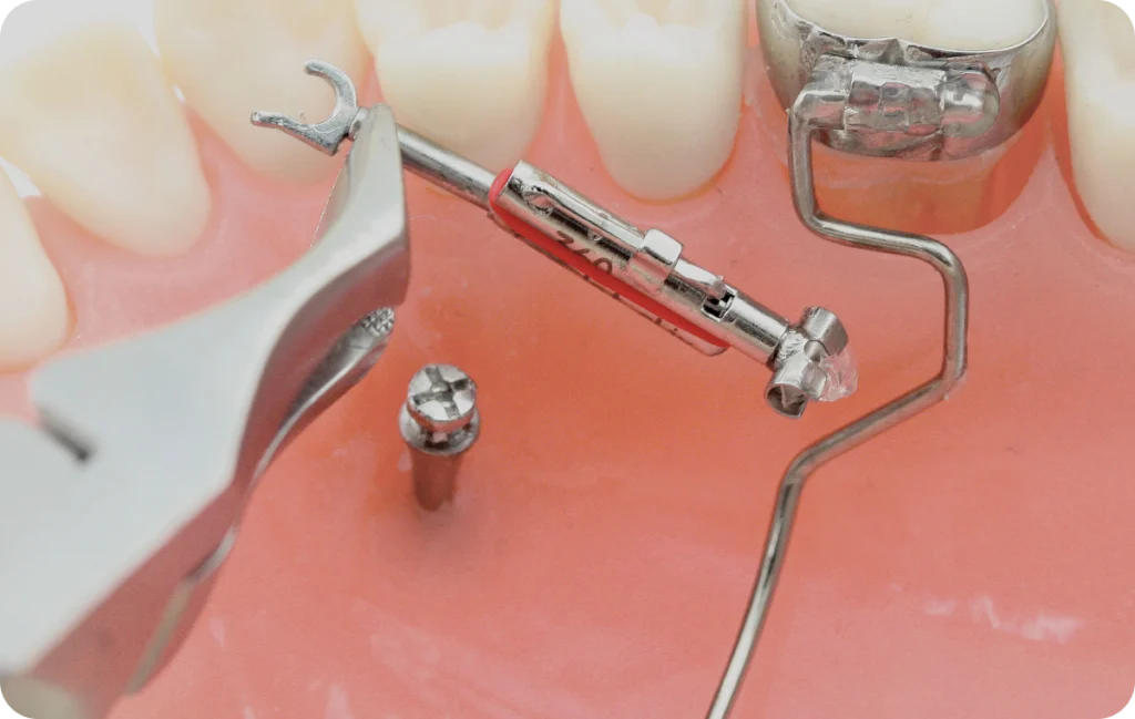 pose mini vis essonne pose mini vis essonne Pose de mini-vis orthodontiques Dentistes Essonne | Apolline Dental Care
