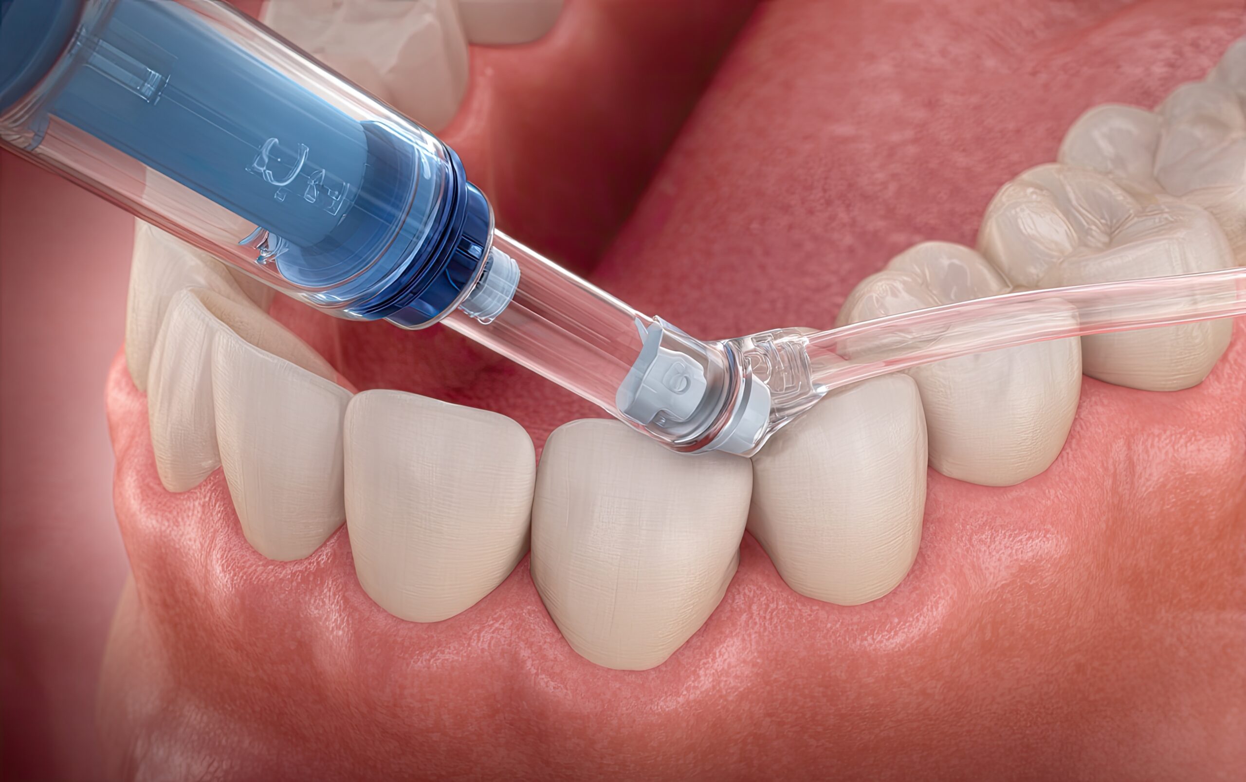Traitement MIH avec résine ICON pour corriger l’hypominéralisation de l’émail à Apolline Dental Care à Corbeil-Essonnes