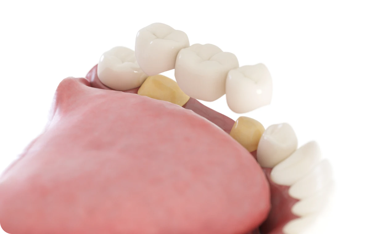 bridge soins dentaires essonne Bridge collé cantilever Dentistes Essonne | Apolline Dental Care