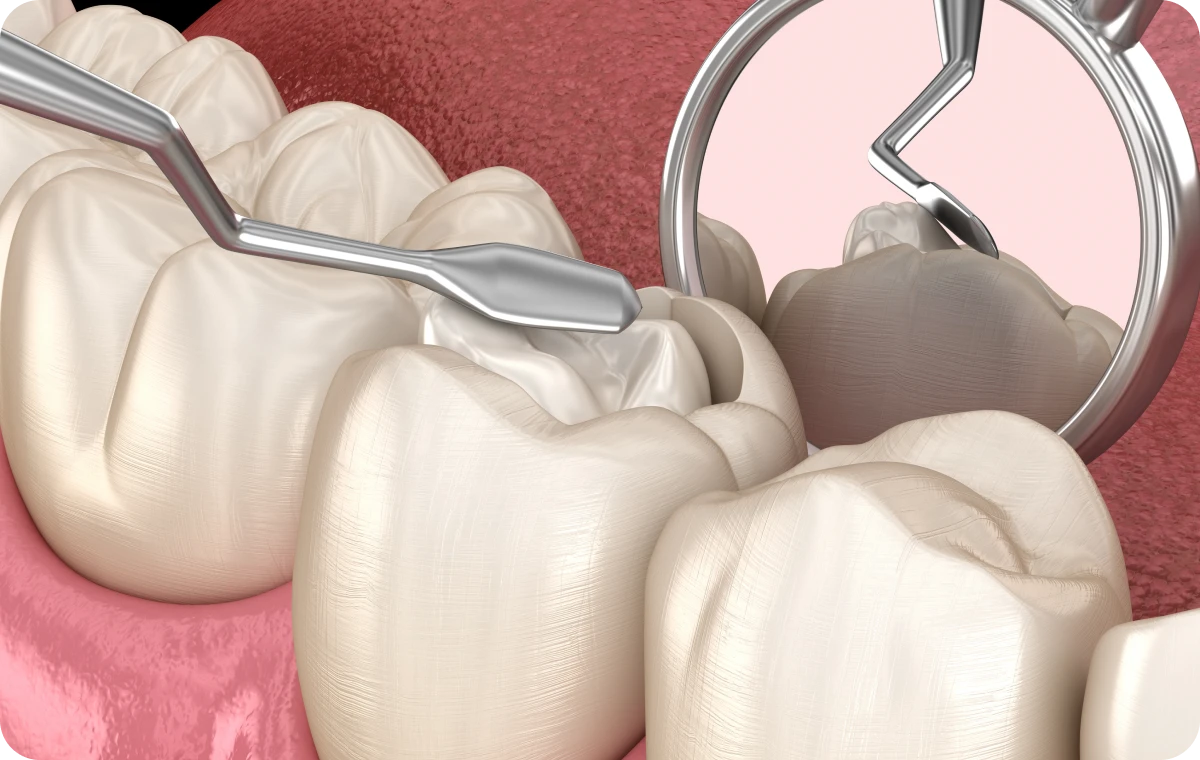 Restauration dentaire en composite esthétique à Apolline Dental Care à Corbeil-Essonnes