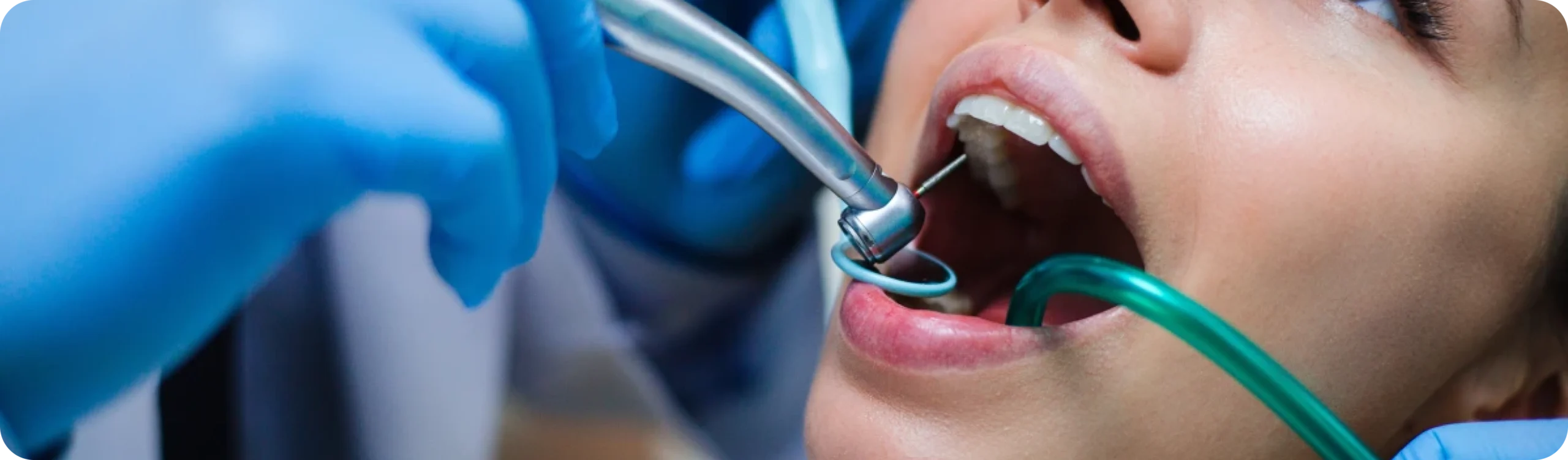 parodontologie dentiste essonne scaled Dentistes Essonne | Apolline Dental Care