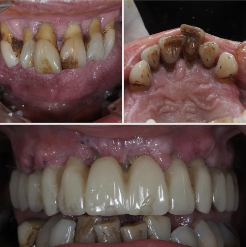 allonx 3 All on 6 - Guide a étage - Mise en Charge immediate Dentistes Essonne | Apolline Dental Care