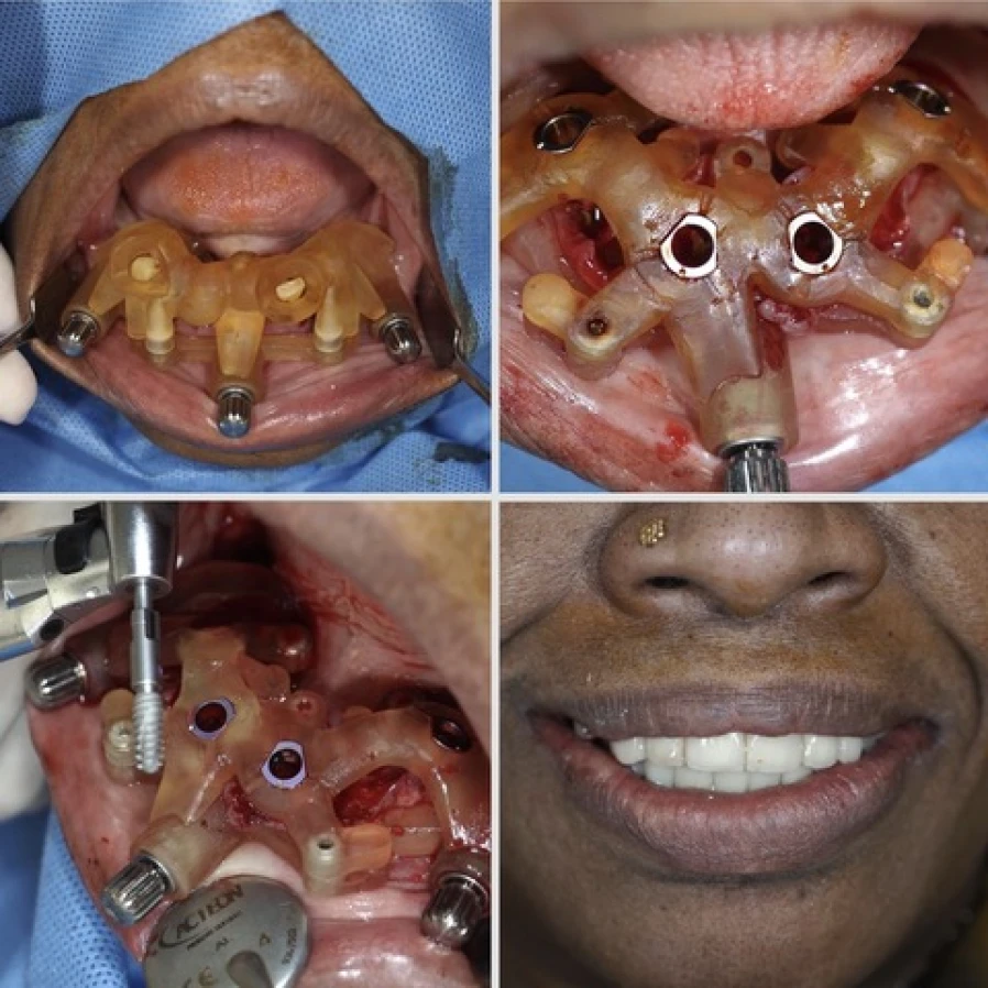 all on 4 mise en charge immediate All on 4 - Guide a étage - Mise en Charge immediate Dentistes Essonne | Apolline Dental Care