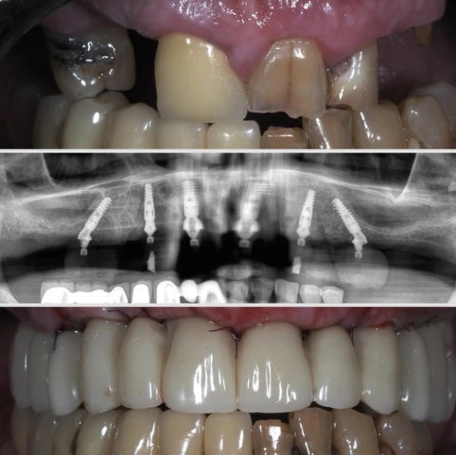 all on 6 guide a tage mise en charge immediate All on 6 - Guide a étage - Mise en Charge immediate Dentistes Essonne | Apolline Dental Care
