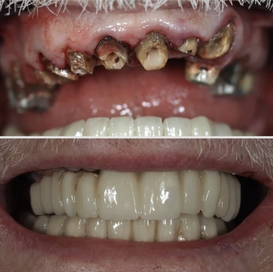 all on 6 mise en charge immediate 2 All on 6 - Guide a étage - Mise en Charge immediate Dentistes Essonne | Apolline Dental Care