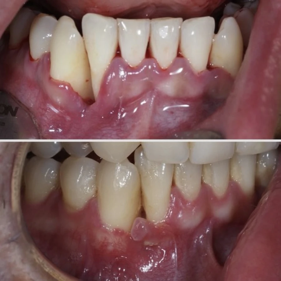 Greffe de gencive déplacée réalisée chez un patient fumeur à Apolline Dental Care à Corbeil-Essonnes