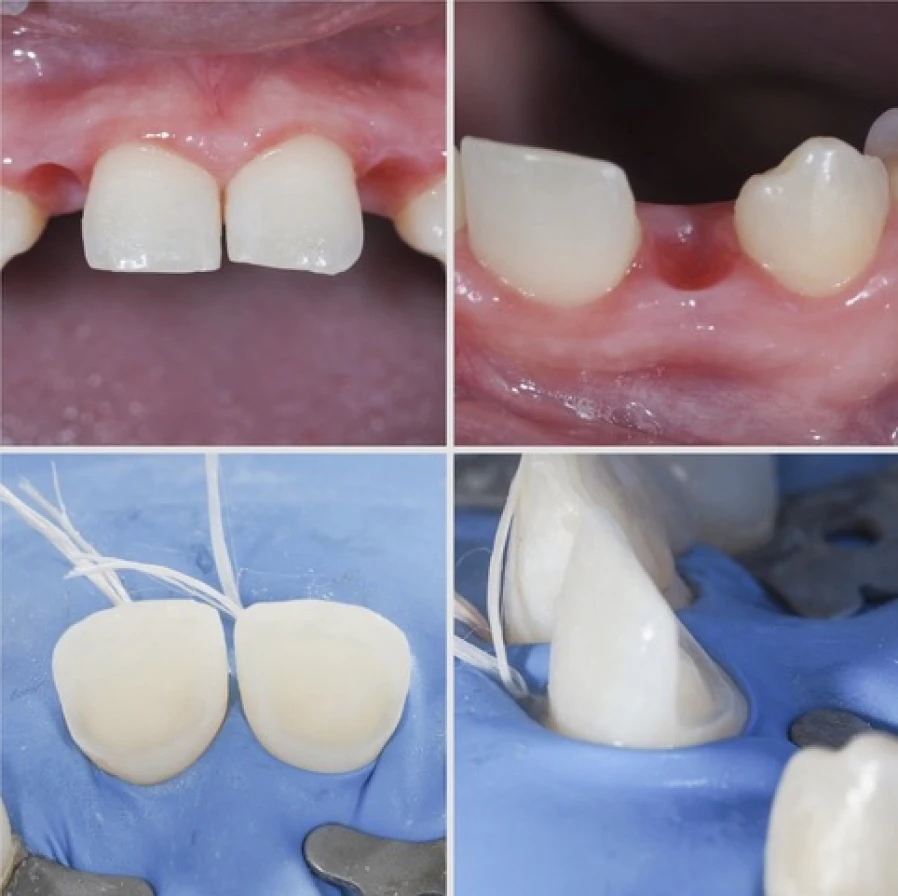 cantilever 1 Bridge Collé Cantilver Dentistes Essonne | Apolline Dental Care