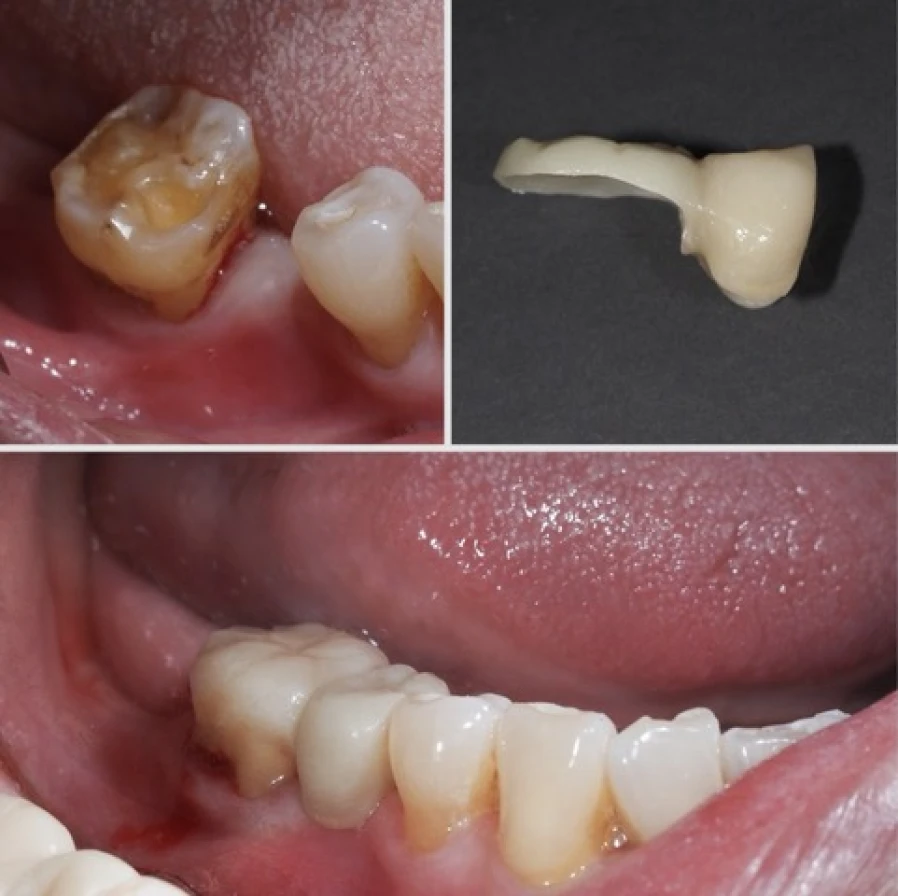 cantilever2 1 Bridge Collé Cantilver Posterieur Dentistes Essonne | Apolline Dental Care