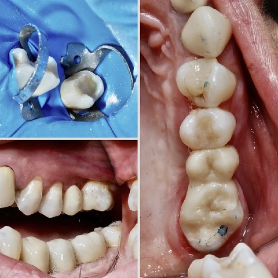 cantilever3 Bridge Collé Cantilver Posterieur Dentistes Essonne | Apolline Dental Care
