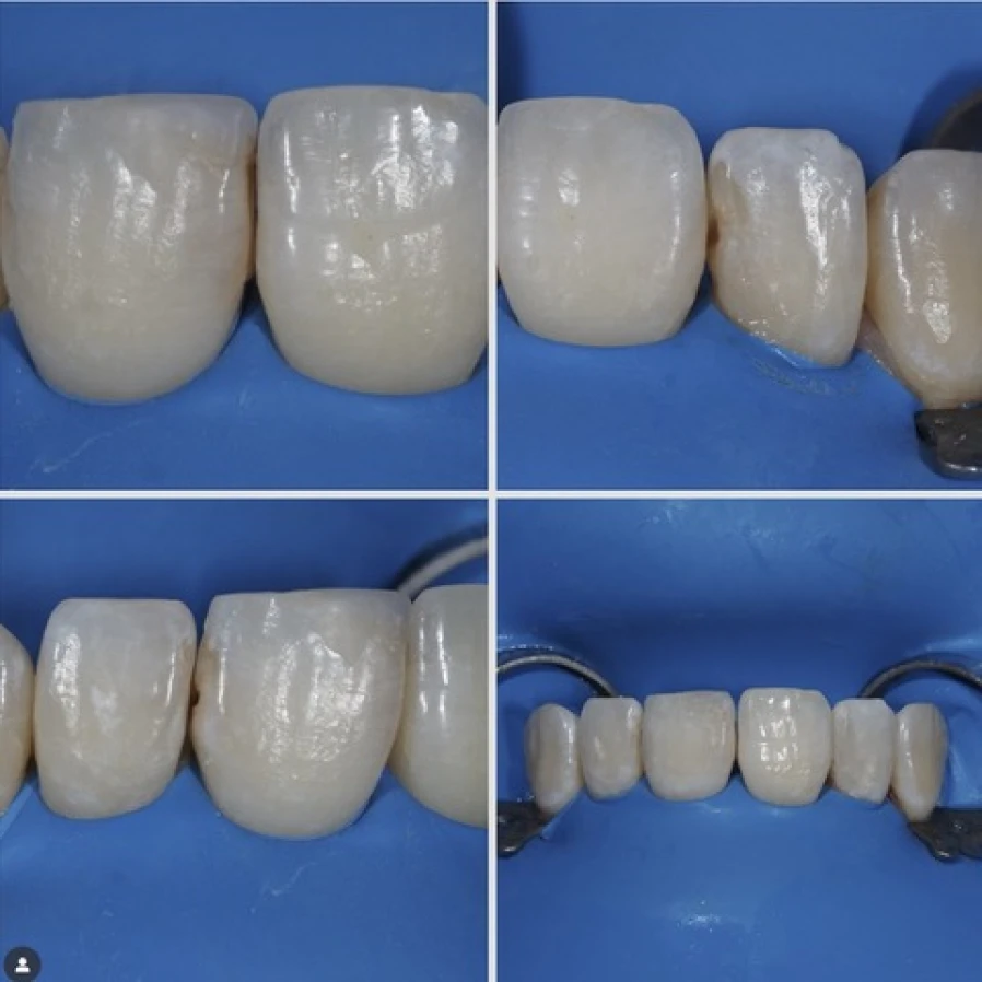 compo 2 Bridge Collé Cantilver Posterieur Dentistes Essonne | Apolline Dental Care