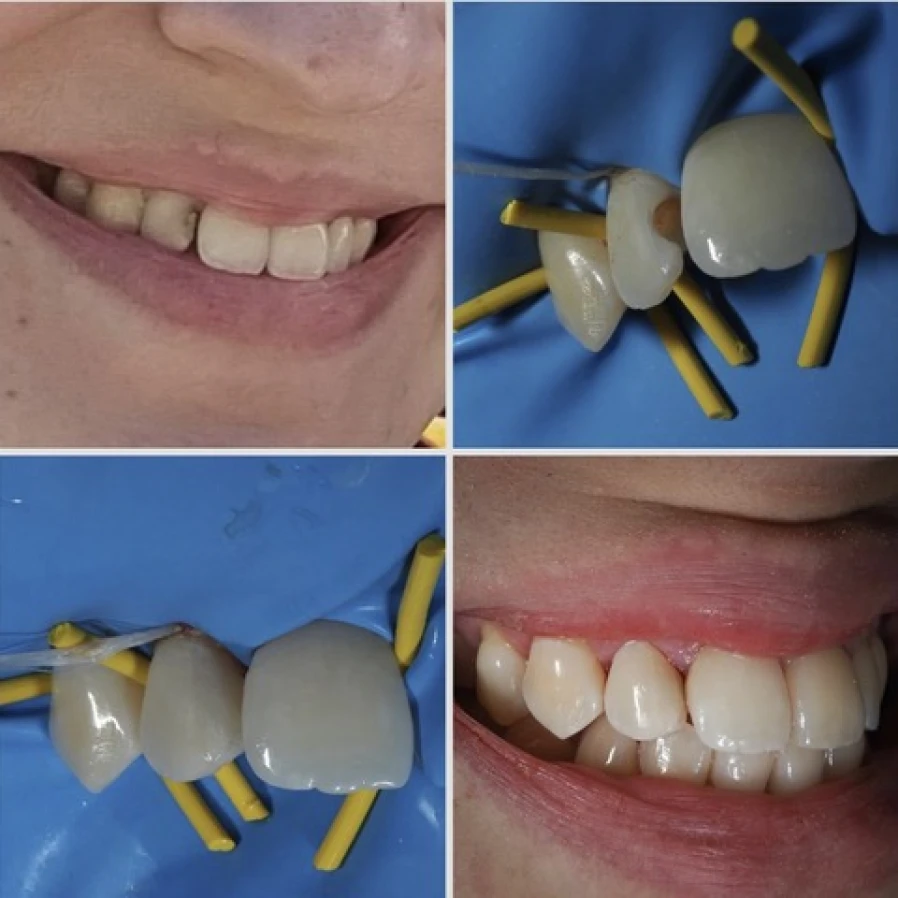 compo Bridge Collé Cantilver Posterieur Dentistes Essonne | Apolline Dental Care