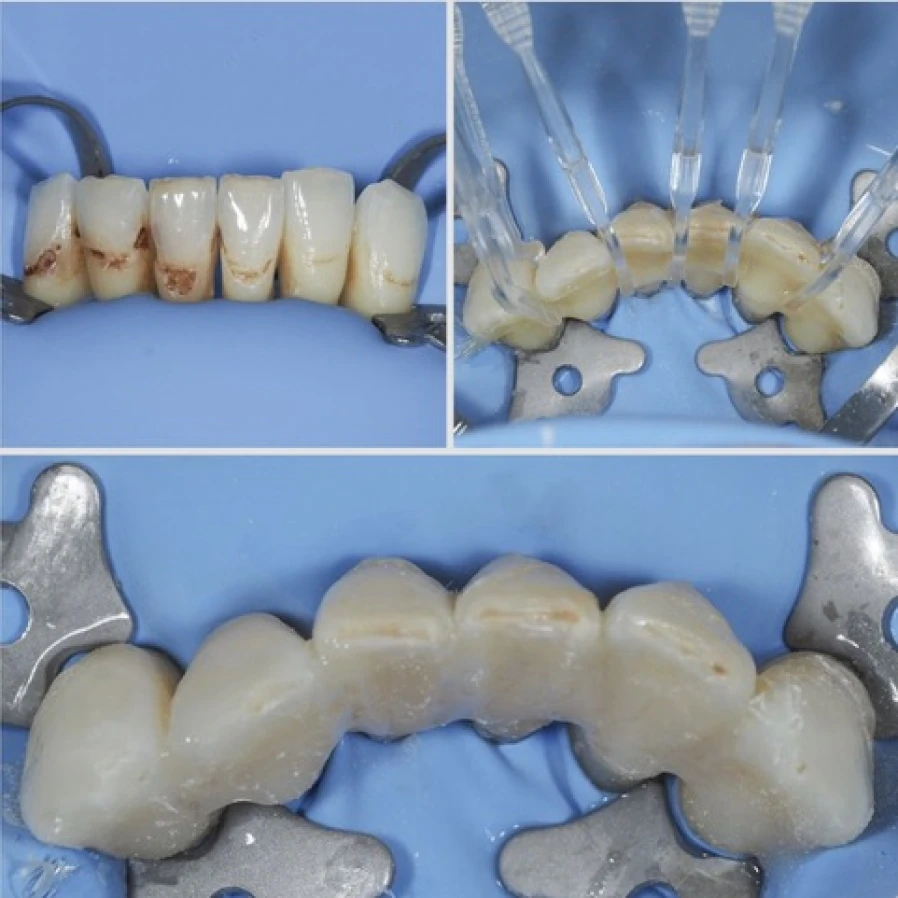 contention Bridge Collé Cantilver Posterieur Dentistes Essonne | Apolline Dental Care