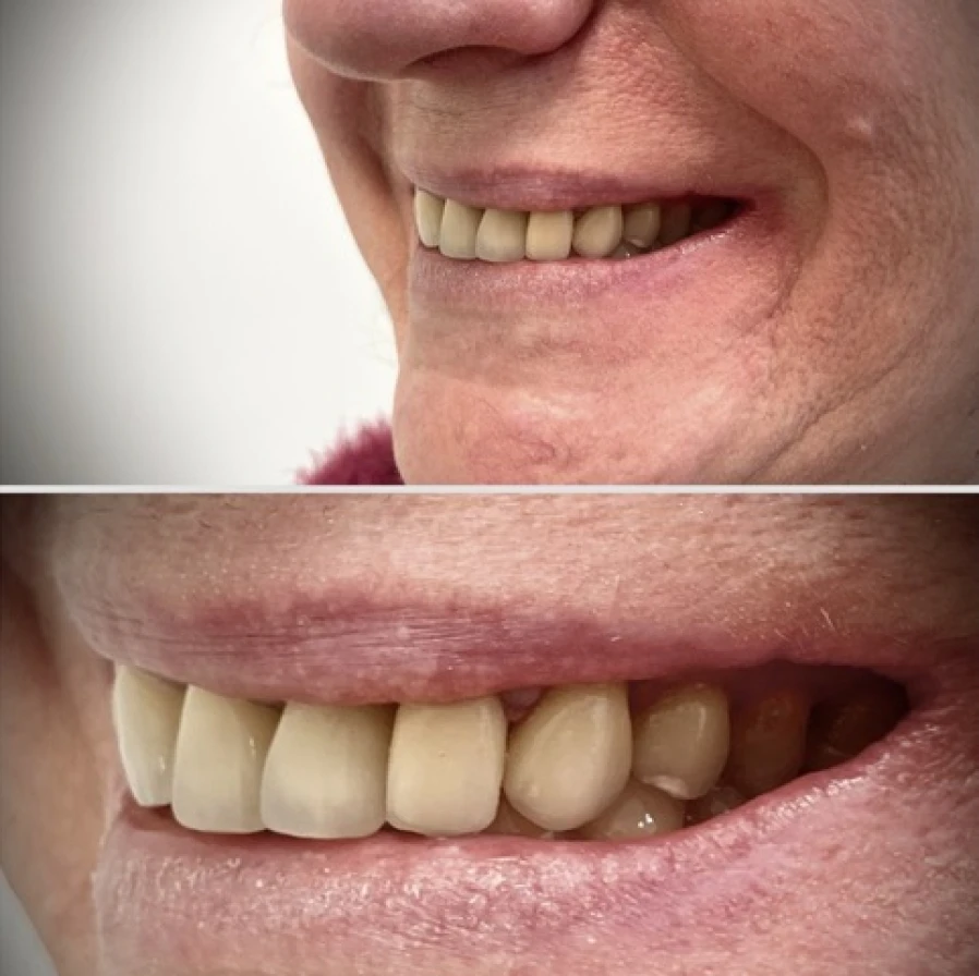 couronne Bridge Collé Cantilver Posterieur Dentistes Essonne | Apolline Dental Care