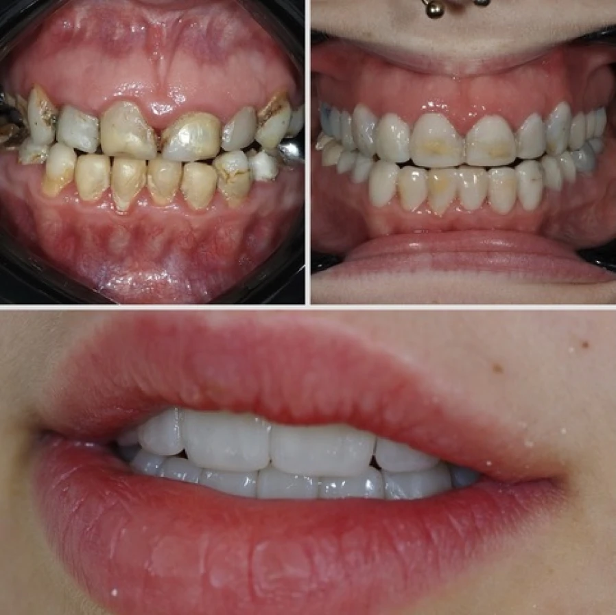 couronne2 Bridge Collé Cantilver Posterieur Dentistes Essonne | Apolline Dental Care