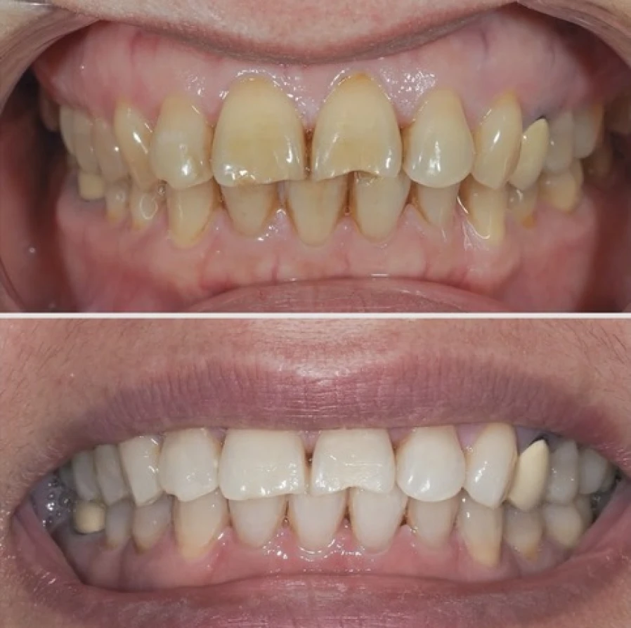 eclaircissement Bridge Collé Cantilver Posterieur Dentistes Essonne | Apolline Dental Care