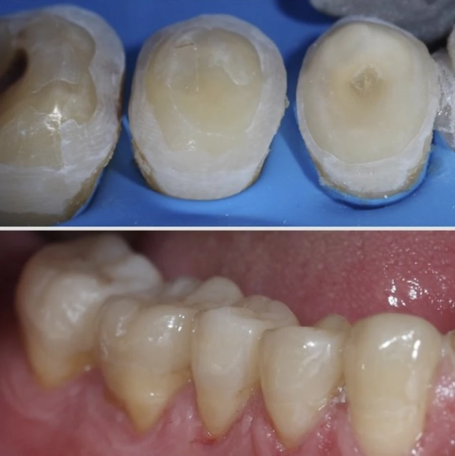 erosion Bridge Collé Cantilver Posterieur Dentistes Essonne | Apolline Dental Care