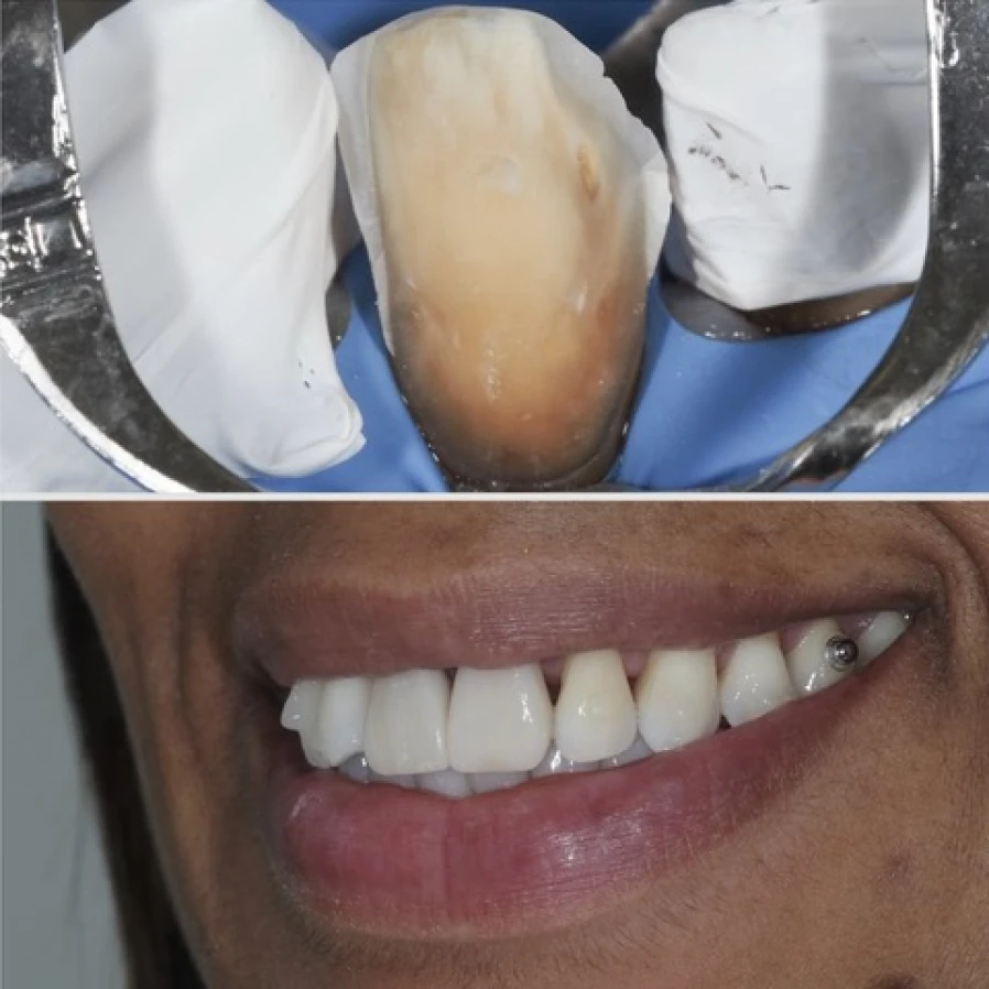 facette 2 Bridge Collé Cantilver Posterieur Dentistes Essonne | Apolline Dental Care