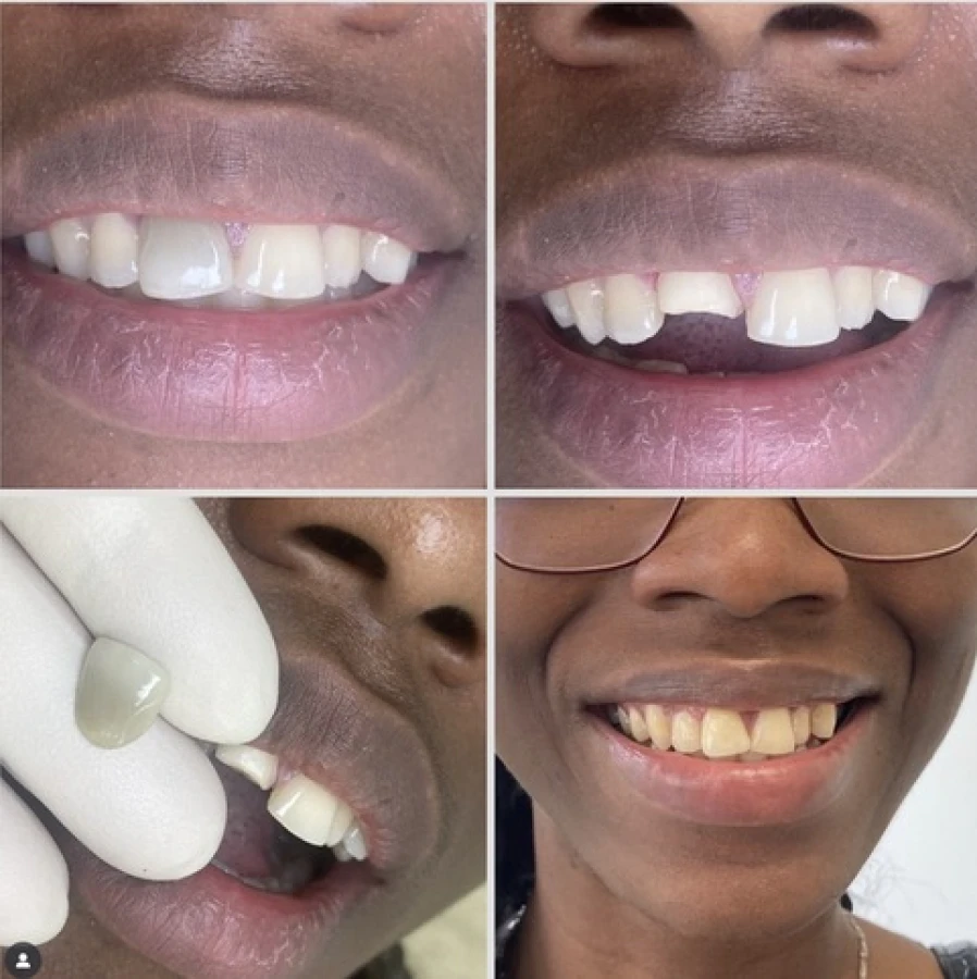 facette 3 Bridge Collé Cantilver Posterieur Dentistes Essonne | Apolline Dental Care