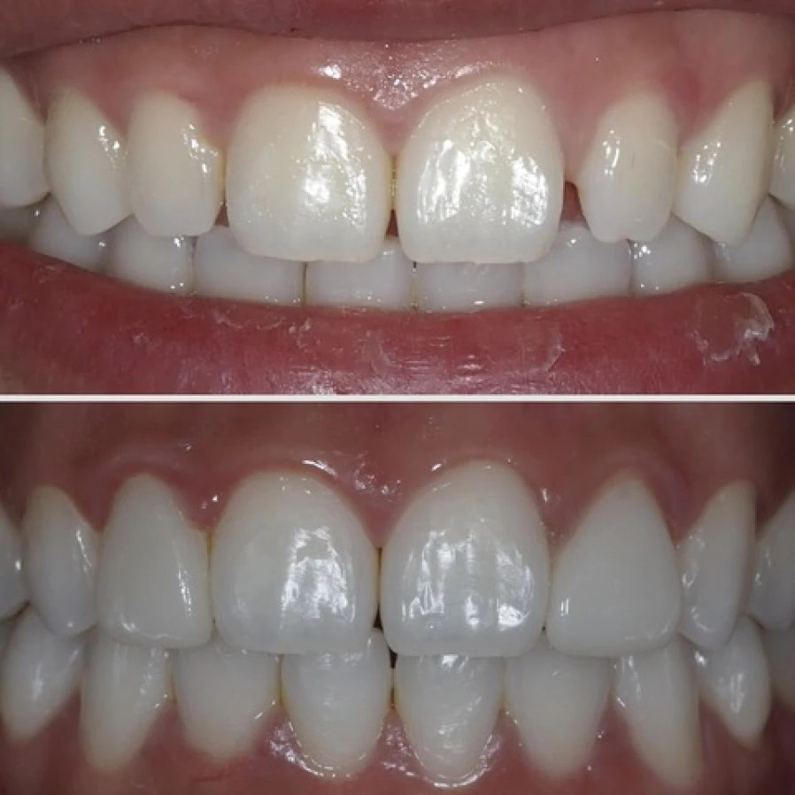 facette Bridge Collé Cantilver Posterieur Dentistes Essonne | Apolline Dental Care